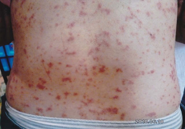 すねの湿疹はどうやって治すの?